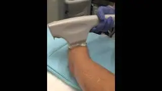Watch a Live BBL Therapy Treatment to Arm