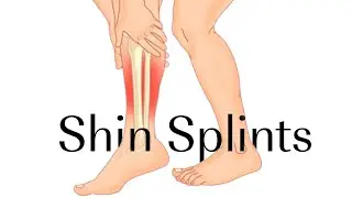 Shin Splints Treatment: Expert Physiotherapy Tips for Fast Recovery
