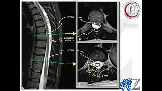 Syringomyelia  (Part 2) تكيس النخاع الشوكي