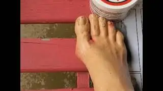 Diabetes Education: Foot Care