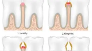 Nature's Smile Gum balm - Advanced Solution To Prevent Periodontal Disease