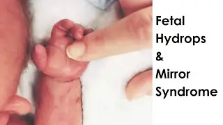 C-Section Birth and Death of Our Baby Addelyn from Fetal Hydrops During COVID-19 Pandemic