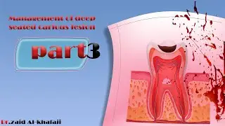 شرح  Pulpotomy | (محاضرة جامعة الرافدين)