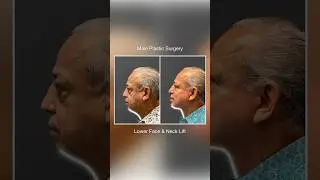 Male Facial Rejuvenation: Lower Face & Neck Lift | Paul N. Afrooz, MD