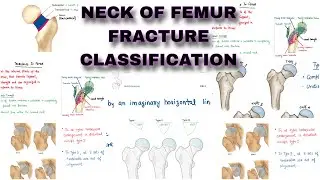NECK OF FEMUR - Fracture Classification