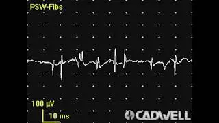 Taking the Mystery Out of an EMG/NCS Report &ndash; Part 2 (Video 1)