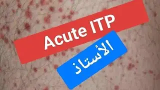 Acute ITP