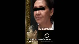 Rejuvenecimiento Facial - El Poder Transformador de FaceTite y Morpheus8 en la Belleza Natural
