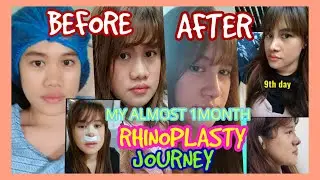 MY GORETEX SEPTORHINOPLASTY JOURNEY BY DR ALFRED DIZON OF PAMPANGA