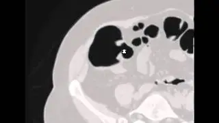 virtual colon: Lipomatous hypertrophy ileocecal valve. CASE65A.avi