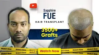 Best Hair Transplant Journey in Bangladesh | 3500 Grafts | Grade 3A | Hairfree & Hairgrow
