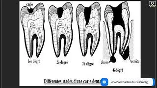 Cours - 3e - SVT : Hygiène de la dent et de la digestion 2/3