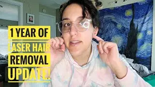 1 Year of Laser Hair Removal and PCOS!