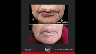 Excellent facial rejuvenation treatment with plasmage&reg;