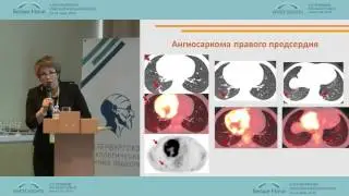 PET / CT diagnosis of cardiac tumors: a demonstration of clinical cases