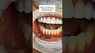 Композитные виниры против фарфоровых виниров #дентальныевиниры #шорты #косметическаястоматология