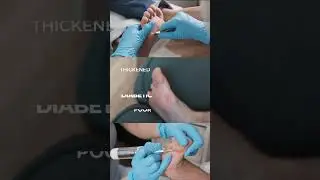 Best Treatment for Diabetic Foot Ulcers | Surat Diabetic Foot and Ulcer Clinic  #diabeticfoot