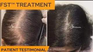 Hair Growth Treatment with FST Treatment | Dr Suruchi Puri | Dermatologist | Severe Hair Loss