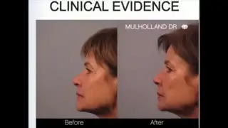 EnergyJet&trade; - Clinical Evidence | Results
