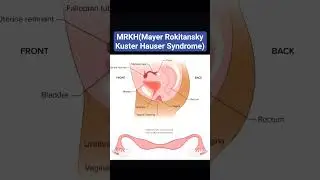 #ytshort#MRKH syndrome||anatomy#physiology#biology#education#neet#aiims#education#helthtips#shorts#