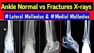Ankle Fracture X-rays | Fracture Medial , Lateral , Posterior & Both Malleolus | UdayXRay