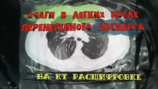 УПЛОТНЕНИЕ стенок бронхов на КТ , ОЧАГИ в легких на КТ расшифровке после АБСЦЕССА легкого