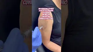 MICRONEEDLING BETWEEN LASER TATTOO REMOVAL SESSIONS 🌟#tattoofun #tattooremovalmethods #laser