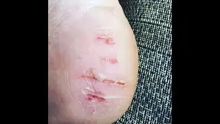 How to prevent swim fin cuts
