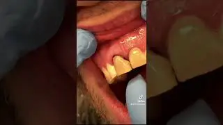 Tooth fracture, dental trauma