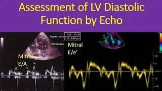 Assessment of LV Diastolic Function by Echo