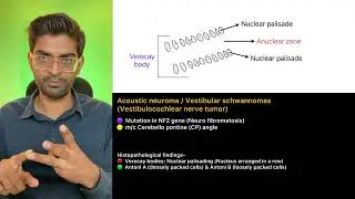 Acoustic neuroma / Vestibular schwanoma