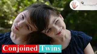Conjoined Twins: Top 10  Facts You 🅳🅾🅽'🆃 Need to Know! ~ Body Bizarre!
