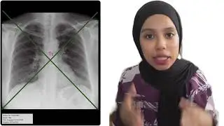 AP CHEST PROJECTION