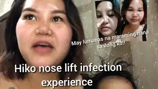 My Hiko nose lift got infected #Hikonoselift #noselift #infected #nosejob #nosefiller