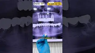 Cum arată un tratament eșuat cu implanturi dentare?
