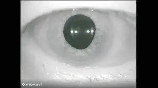 Normal Human Ocular Counter-Roll