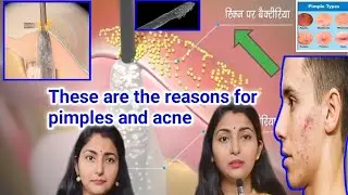 Pimple Acne Caused by Face Mites and Bacteria🧐 क्या आपको पता है फेस माइट्स  और बैक्टीरिया से होता है
