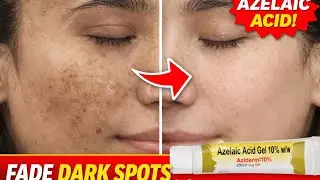 Azelaic Acid for Dark Spots | Pigmentation Treatment at Home
