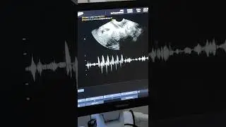 Hearing Baby's Heartbeat for the first time🥰🥰        7 weeks pregnancy ultrasound❤️ #shorts #reels