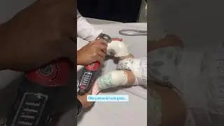 Small Baby Clubfoot Treatment | Plaster Cast Removal & Foot Correction Journey #bellybump
