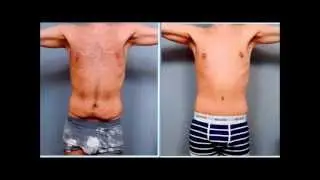 Male Tummy Tuck | Case Study | Dr. Sterry