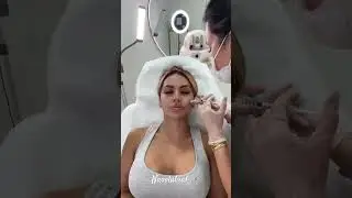 SMILE LINES GONE IN 60 SECONDS!         (follow for more )#beautyroutine#dermalfillers#antiaging