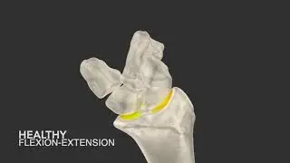Supplemental Video 1. Carpal kinematics in Madelung Deformity.