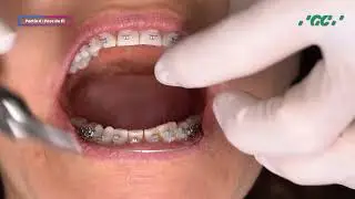Vestibular bonding of self-ligating brackets EXPERIENCE ceramic