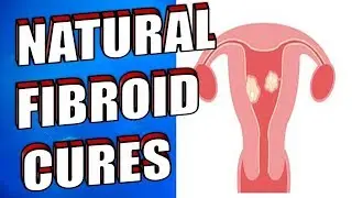20 Natural Ways to Treat & Shrink Fibroids Easily | Natural Cures for Fibroids