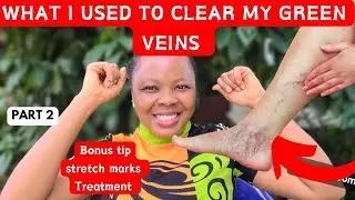 How To Clear Green Veins Fast: 3 Products That will CLEAR SPIDER veins,green veins, varicose veins