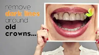 All porcelain crowns @ The Dental Clinic Radlett