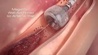 Тромбэктомия при инфаркте миокарда Capture MegaVac Mechanical Thrombectomy System