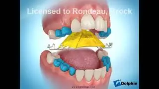 22  Removable 3  way Expander Mx
