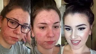 acne coverage foundation routine 2016